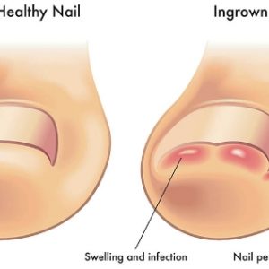 Nail surgery