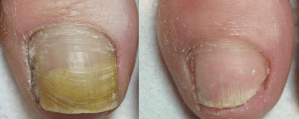 Lunula Laser | Lunula Laser Treatment | Fungal Nail Laser Treatment